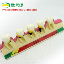 Super September SELL 12585 Classification Model Periodontal 2x Life Size Teeth Disease